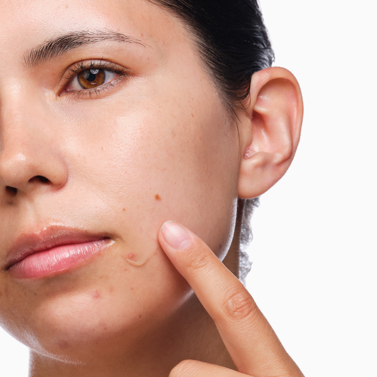 the-acne-set-e6 rdn-the-acne-set-application.png